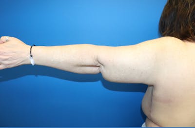 Brachioplasty Before & After Gallery - Patient 899218 - Image 2