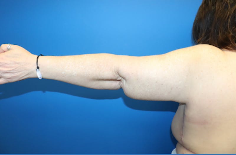 Brachioplasty Before & After Gallery - Patient 899218 - Image 2