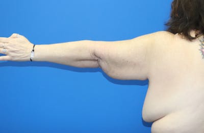 Brachioplasty Before & After Gallery - Patient 899218 - Image 1