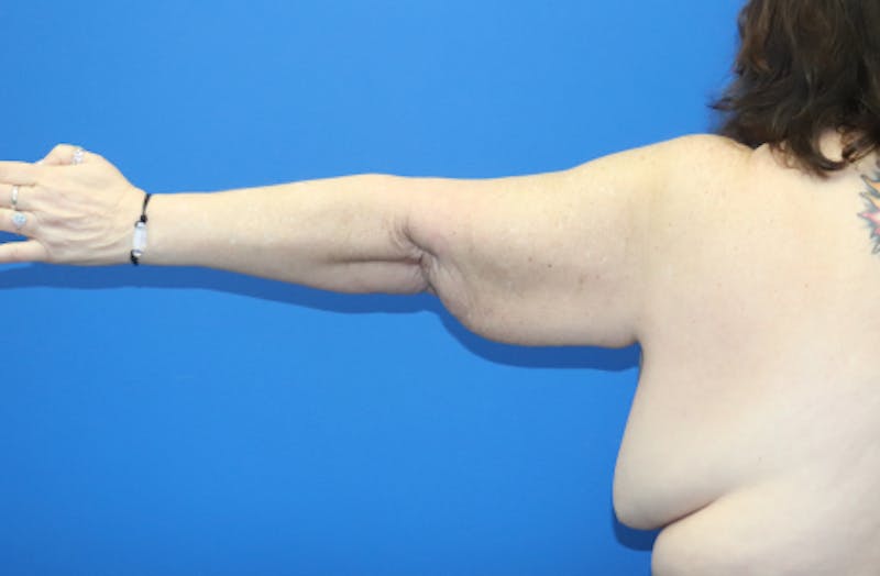 Brachioplasty Before & After Gallery - Patient 899218 - Image 1