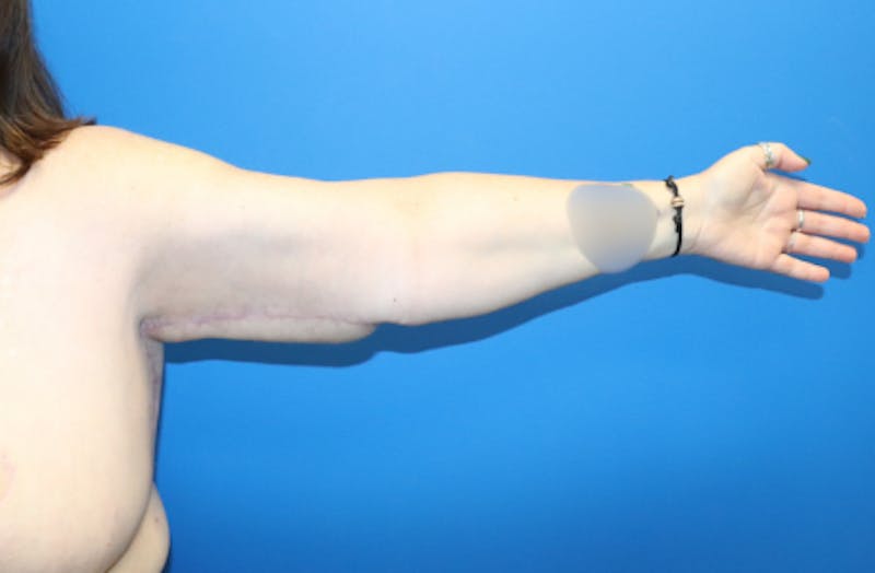 Brachioplasty Before & After Gallery - Patient 899218 - Image 3