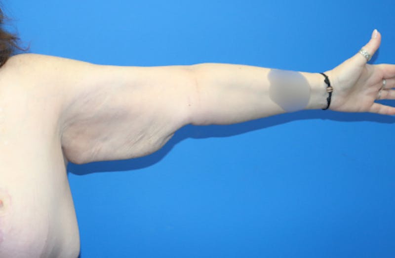 Brachioplasty Before & After Gallery - Patient 899218 - Image 4