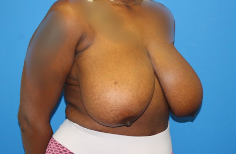 Breast Reduction Before & After Gallery - Patient 170342 - Image 5