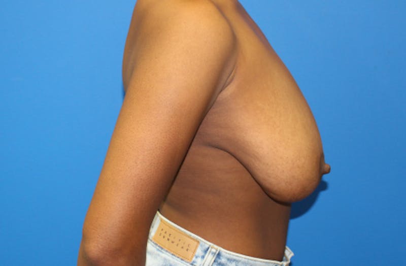 Breast Reduction Before & After Gallery - Patient 182507 - Image 5