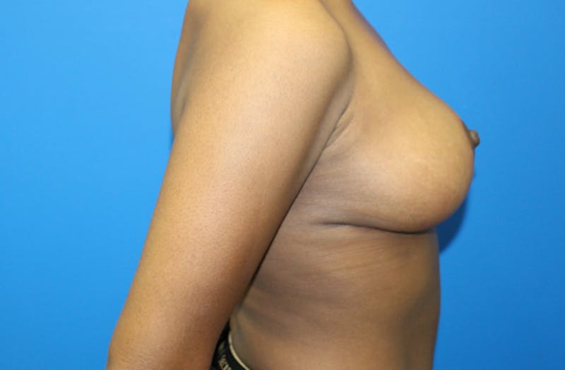 Breast Reduction Before & After Gallery - Patient 182507 - Image 6