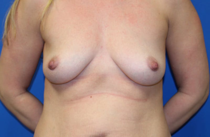 Breast Lift With Augmentation Before & After Gallery - Patient 362310 - Image 1