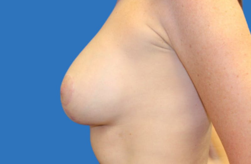 Breast Lift With Augmentation Before & After Gallery - Patient 383365 - Image 6
