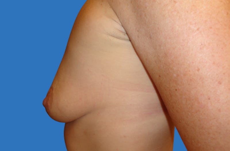 Breast Lift With Augmentation Before & After Gallery - Patient 383365 - Image 5