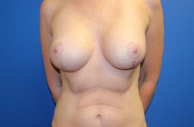 Breast Lift With Augmentation Before & After Gallery - Patient 383365 - Image 2