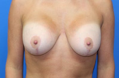 Breast Lift With Augmentation Before & After Gallery - Patient 100089 - Image 2