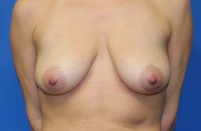 Breast Lift With Augmentation Before & After Gallery - Patient 100089 - Image 1