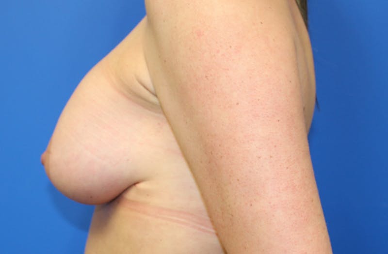 Breast Lift With Augmentation Before & After Gallery - Patient 100089 - Image 6