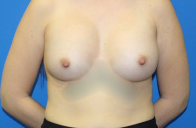 Breast Augmentation Before & After Gallery - Patient 298043 - Image 2