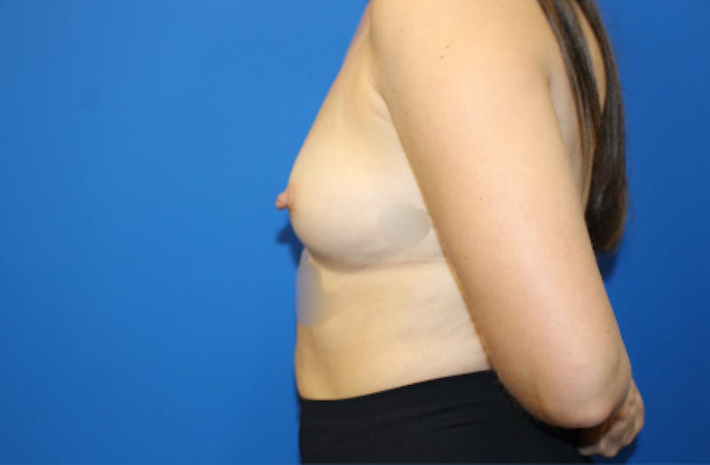 Breast Augmentation Before & After Gallery - Patient 298043 - Image 3