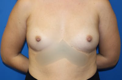 Breast Augmentation Before & After Gallery - Patient 298043 - Image 1