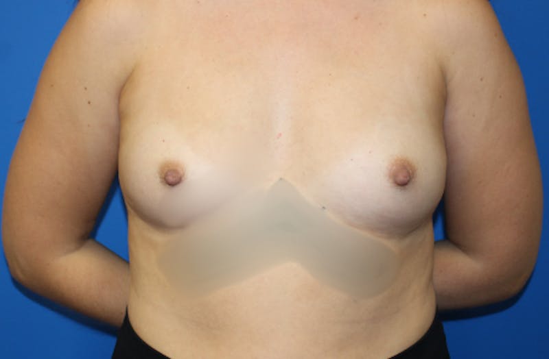 Breast Augmentation Before & After Gallery - Patient 298043 - Image 1