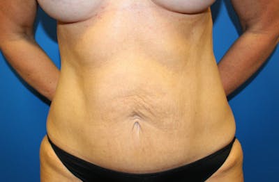 Ellacor Before & After Gallery - Patient 319922 - Image 2