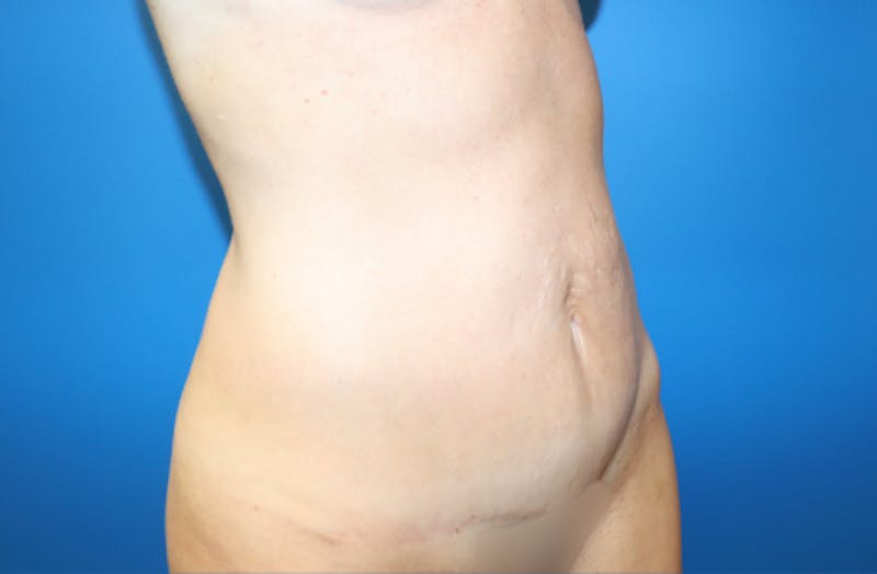 Ellacor Before & After Gallery - Patient 319922 - Image 4