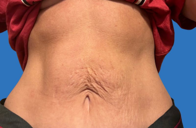 Ellacor Before & After Gallery - Patient 319922 - Image 1