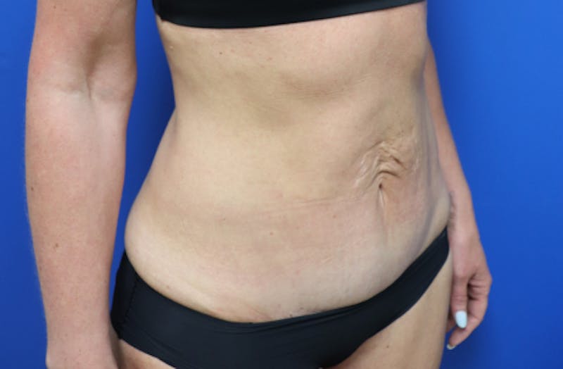 Ellacor Before & After Gallery - Patient 319922 - Image 3