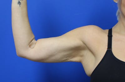 Ellacor Before & After Gallery - Patient 990354 - Image 1