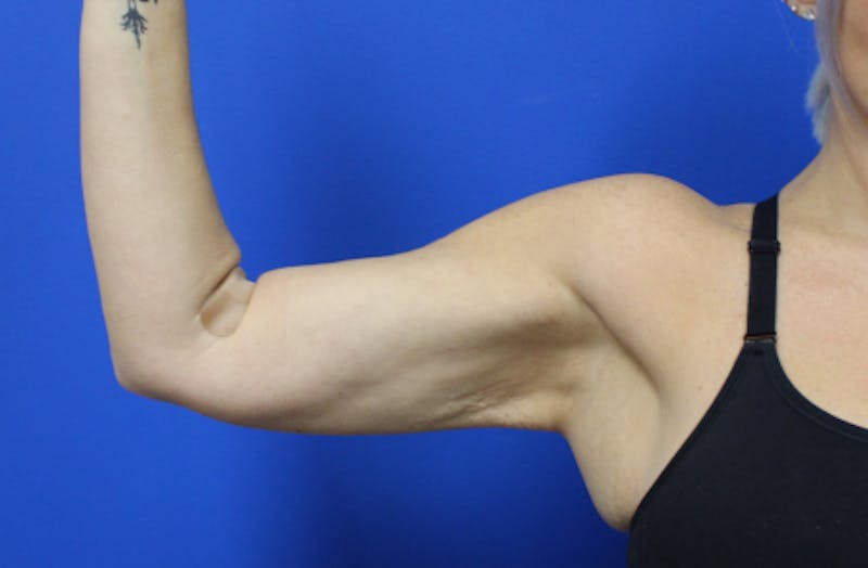 Ellacor Before & After Gallery - Patient 990354 - Image 1
