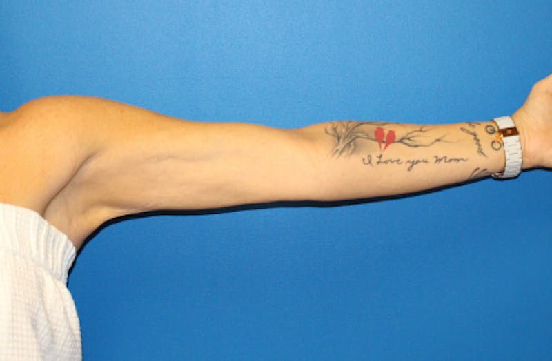 Ellacor Before & After Gallery - Patient 990354 - Image 6
