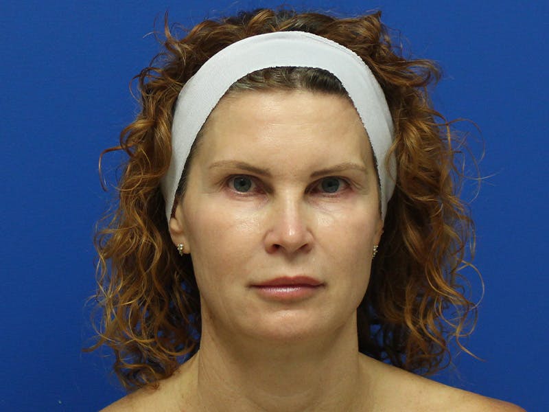 Scarlet RF Microneedling Before & After Gallery - Patient 102775 - Image 1