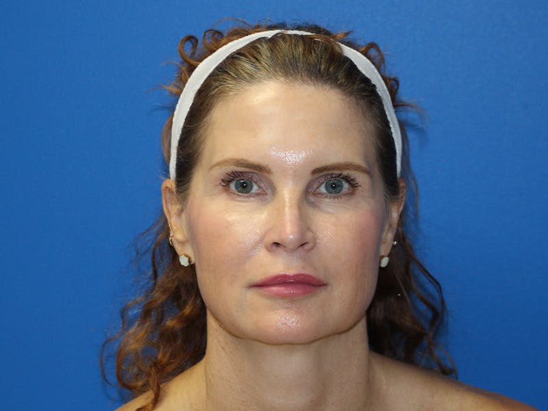 Scarlet RF Microneedling Before & After Gallery - Patient 102775 - Image 2