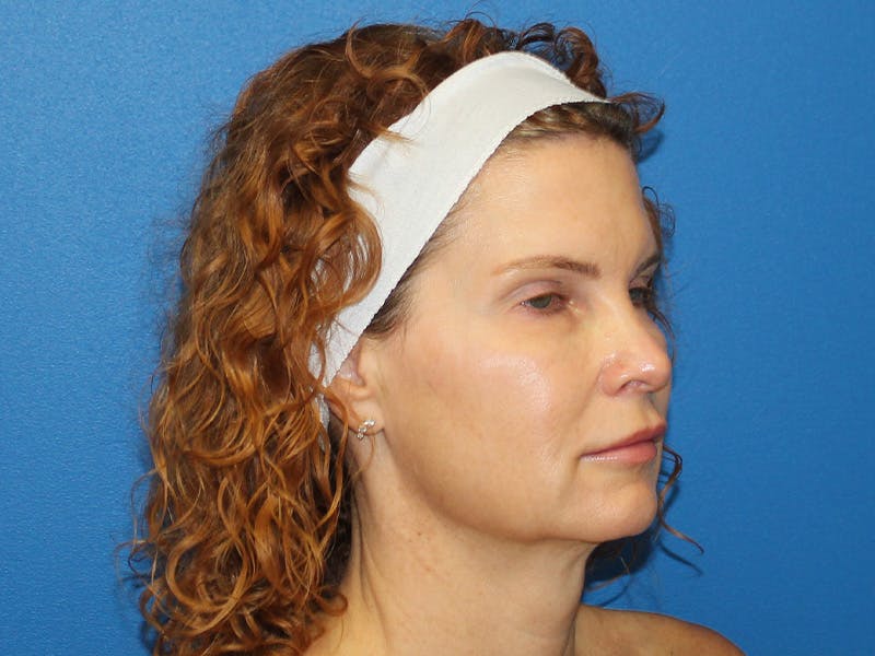 Scarlet RF Microneedling Before & After Gallery - Patient 102775 - Image 3