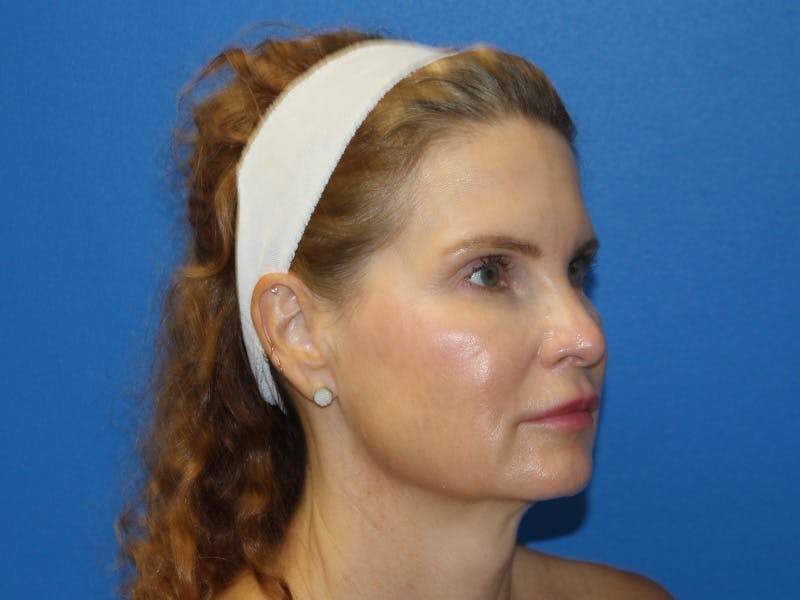 Scarlet RF Microneedling Before & After Gallery - Patient 102775 - Image 4