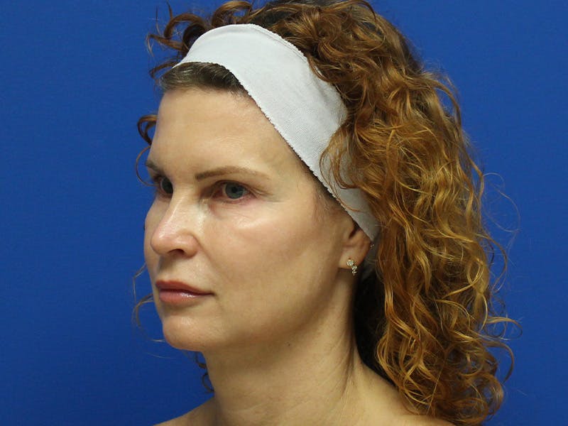 Scarlet RF Microneedling Before & After Gallery - Patient 102775 - Image 5