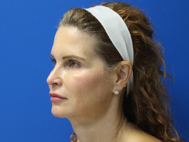 Scarlet RF Microneedling Before & After Gallery - Patient 102775 - Image 6