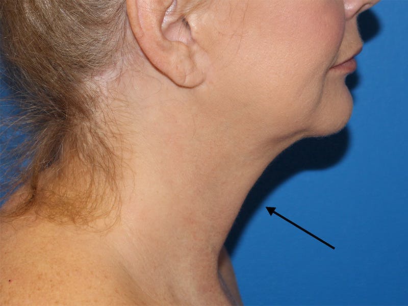 Halo BBL Before & After Gallery - Patient 980971 - Image 1