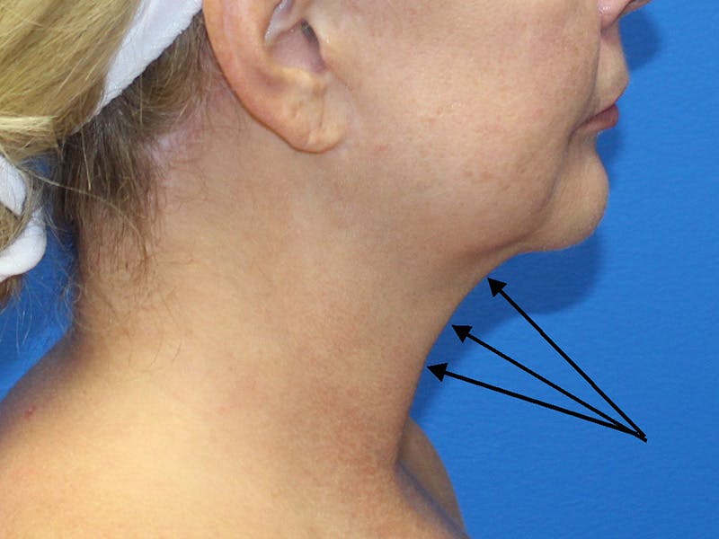 Halo BBL Before & After Gallery - Patient 980971 - Image 2