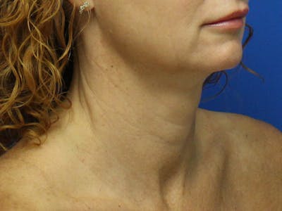 Skin Tightening Before & After Gallery - Patient 596073 - Image 1