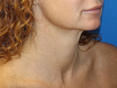 Skin Tightening Before & After Gallery - Patient 596073 - Image 2