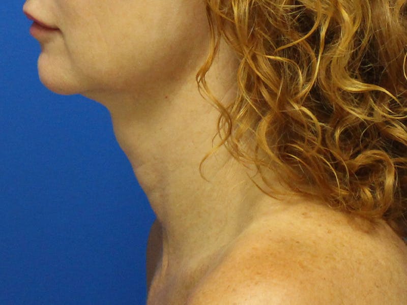 Skin Tightening Before & After Gallery - Patient 596073 - Image 3