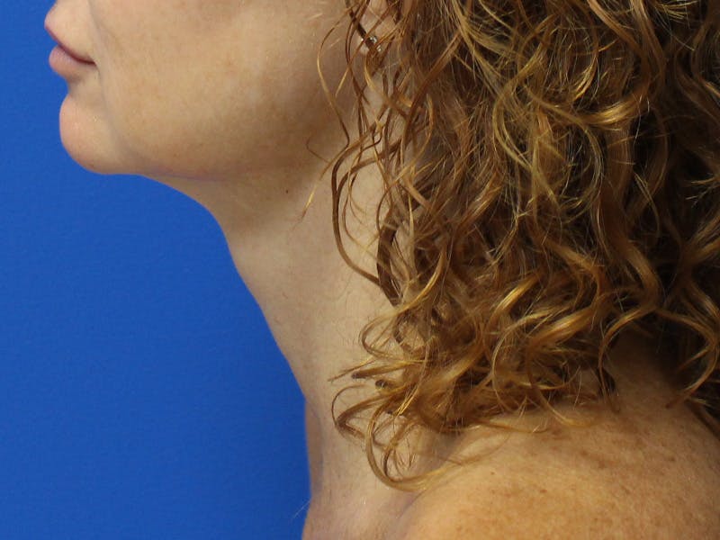 Skin Tightening Before & After Gallery - Patient 596073 - Image 4