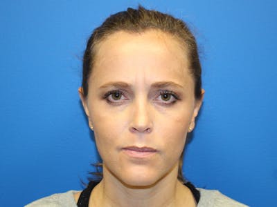 Botox Xeomin Before & After Gallery - Patient 142995 - Image 1