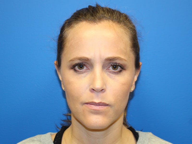 Botox Xeomin Before & After Gallery - Patient 142995 - Image 1