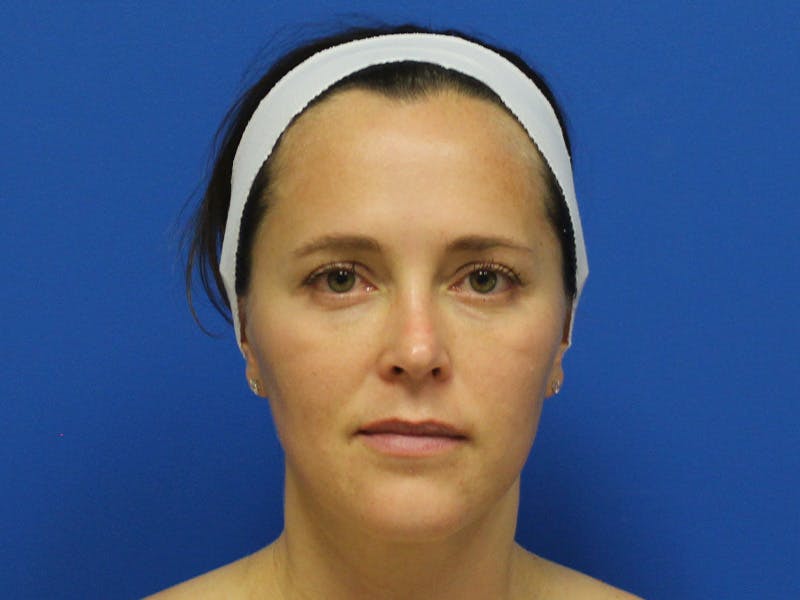 Botox Xeomin Before & After Gallery - Patient 142995 - Image 2