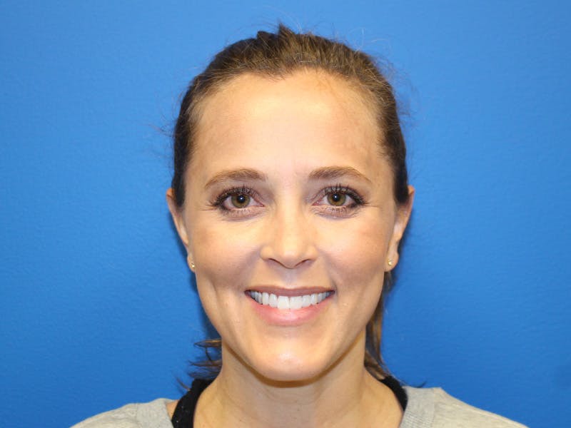Botox Xeomin Before & After Gallery - Patient 142995 - Image 3