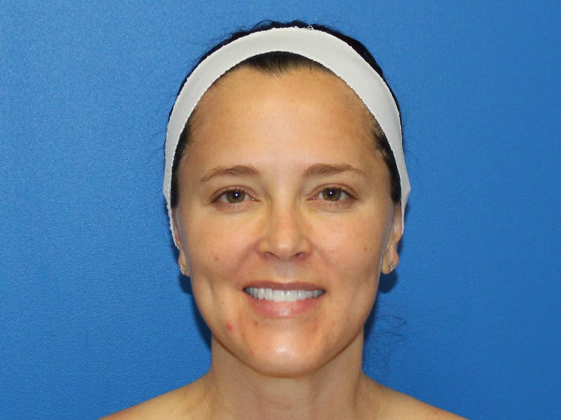 Botox Xeomin Before & After Gallery - Patient 142995 - Image 4