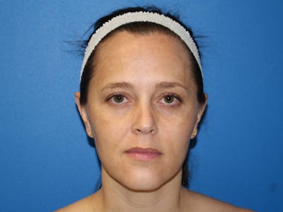 Halo BBL Before & After Gallery - Patient 135081 - Image 1