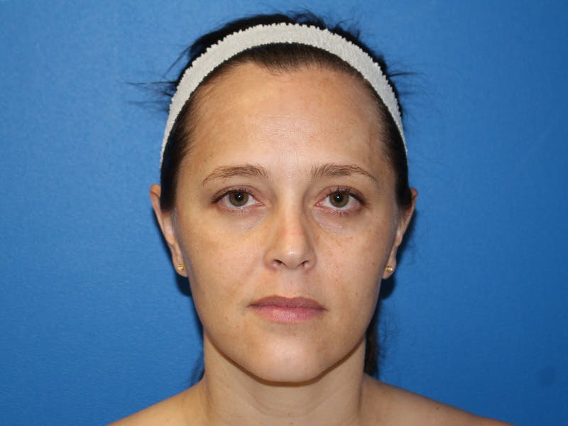 Halo BBL Before & After Gallery - Patient 135081 - Image 1