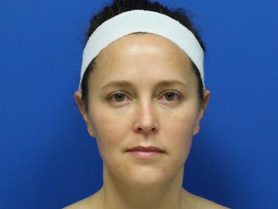 Halo BBL Before & After Gallery - Patient 135081 - Image 2