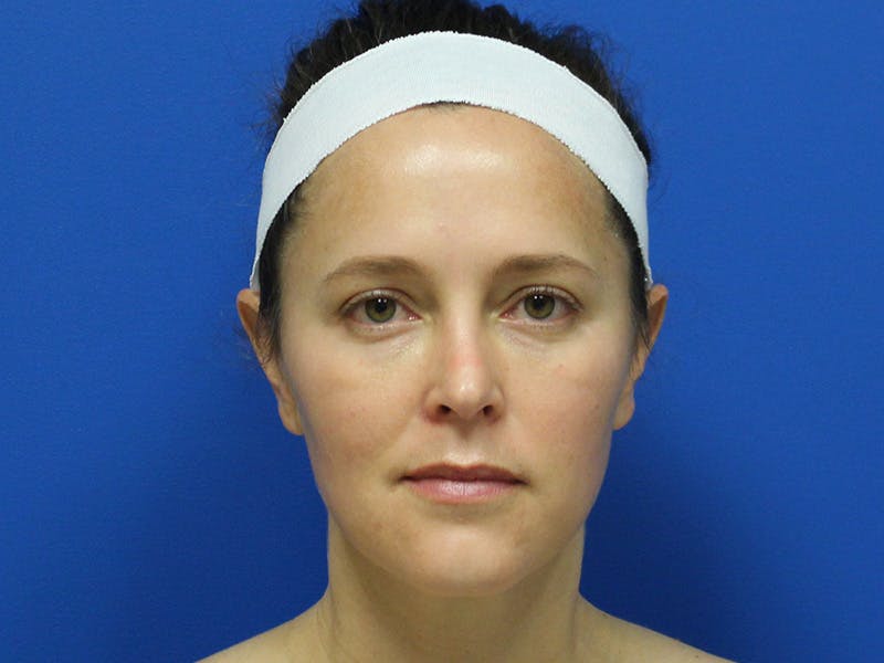 Halo BBL Before & After Gallery - Patient 135081 - Image 2