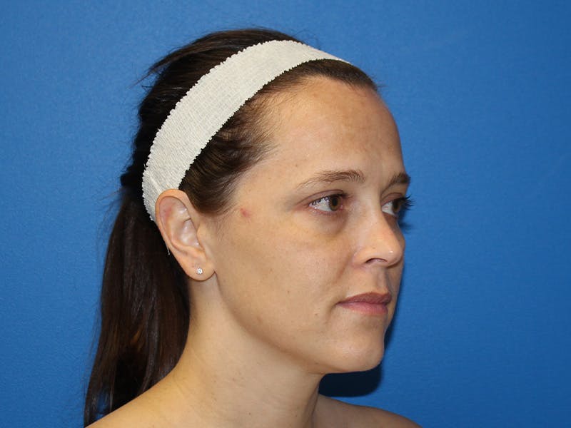 Halo BBL Before & After Gallery - Patient 135081 - Image 3
