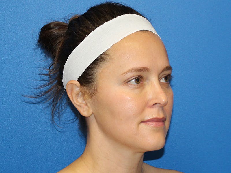 Halo BBL Before & After Gallery - Patient 135081 - Image 4
